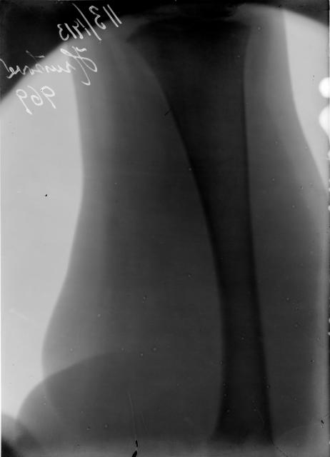 Rentgen Hruškové 1913   rentgen,Hrušková